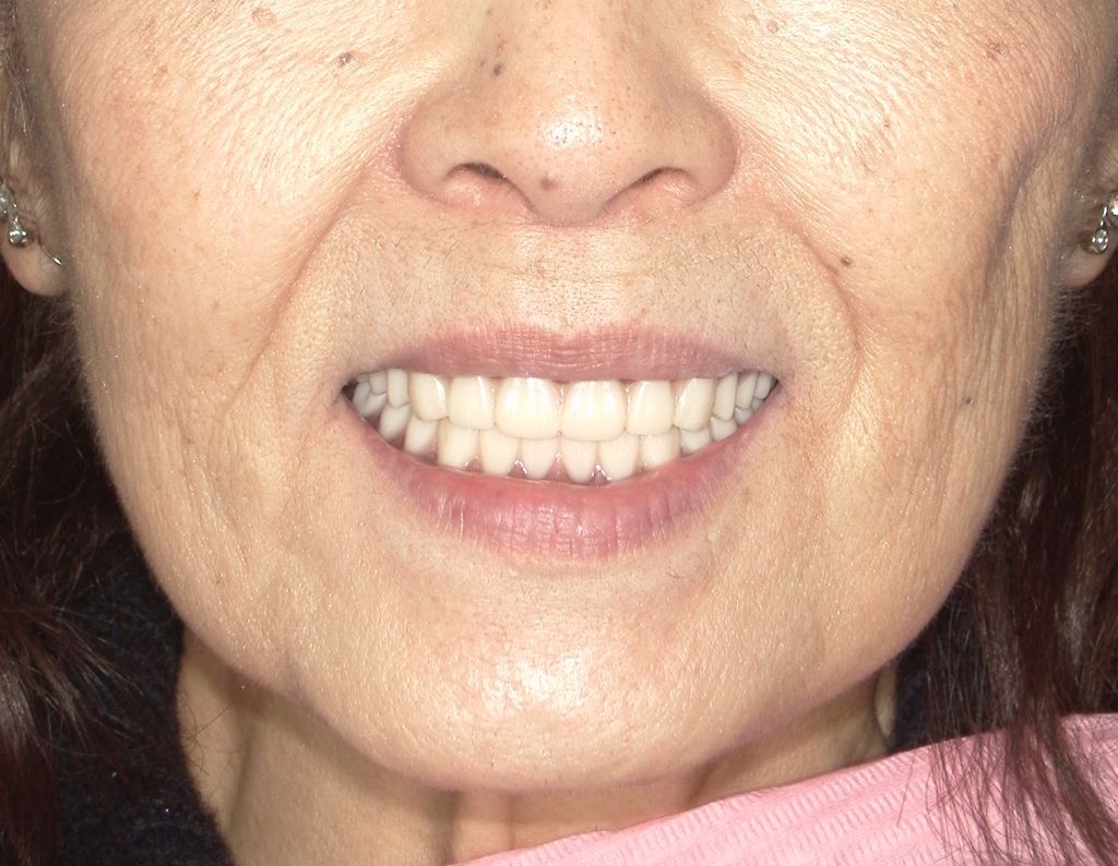 治療後の美しい笑顔の患者様