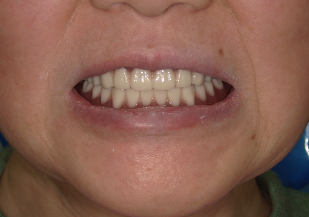 治療後の自然な笑顔の患者様